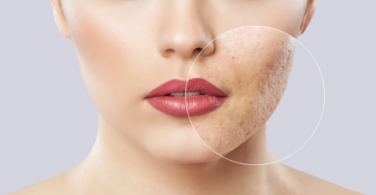 Acne Scar Treatment in Kondapur