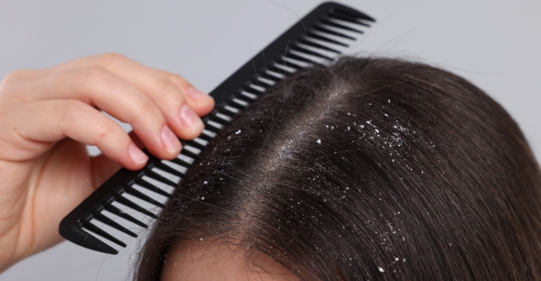 Advanced Treatments for Hair Loss & Dandruff Treatment in Kondapur